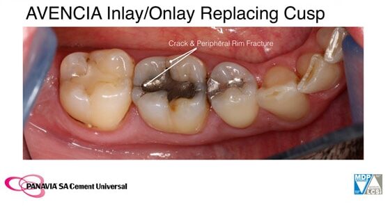 Case Study - AVENCIA Inlay/Onlay